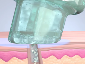 Step 2: GENTLE PEEL